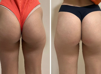 Bumbum na nuca